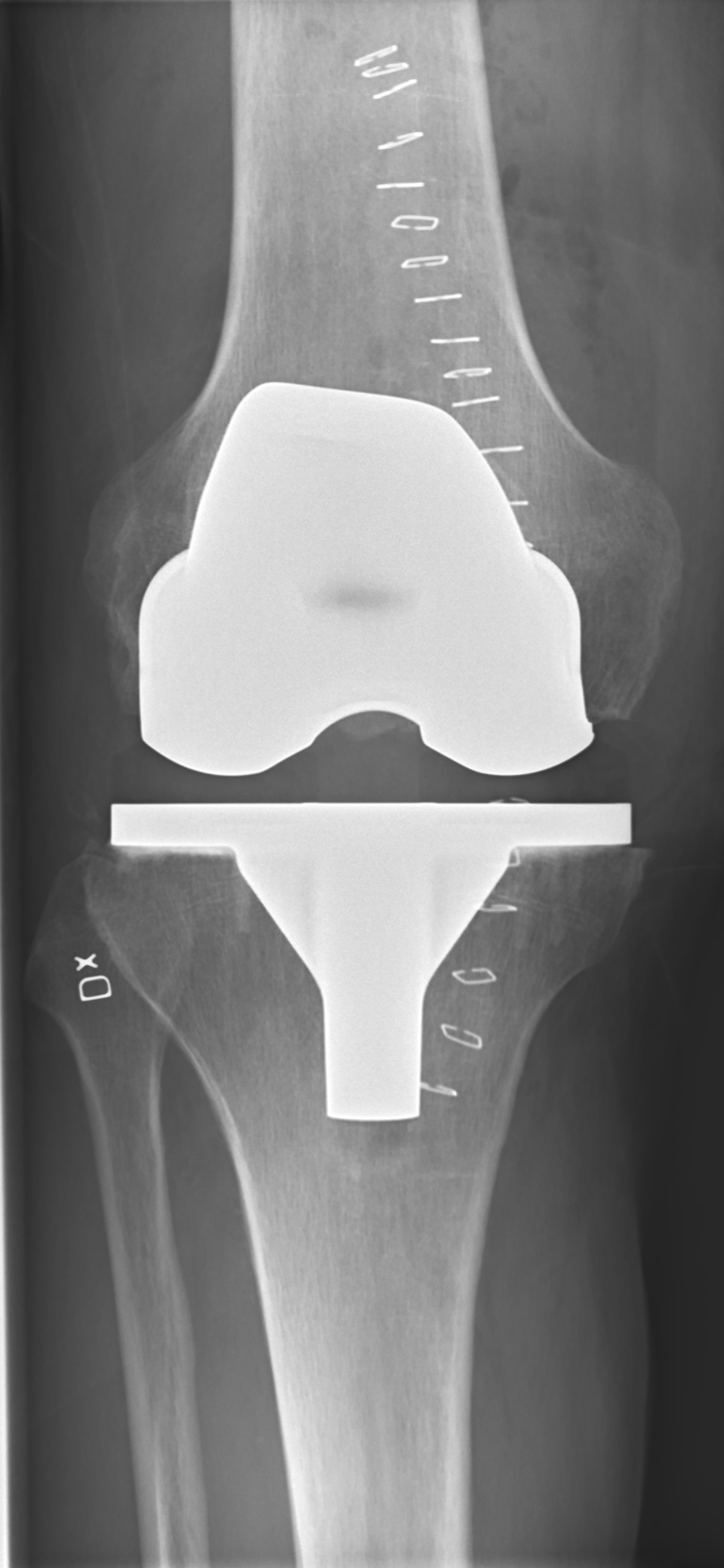 X-ray of a total knee replacement prosthesis — orthopaedics spin-off and Johnson & Johnson Q3 earnings
