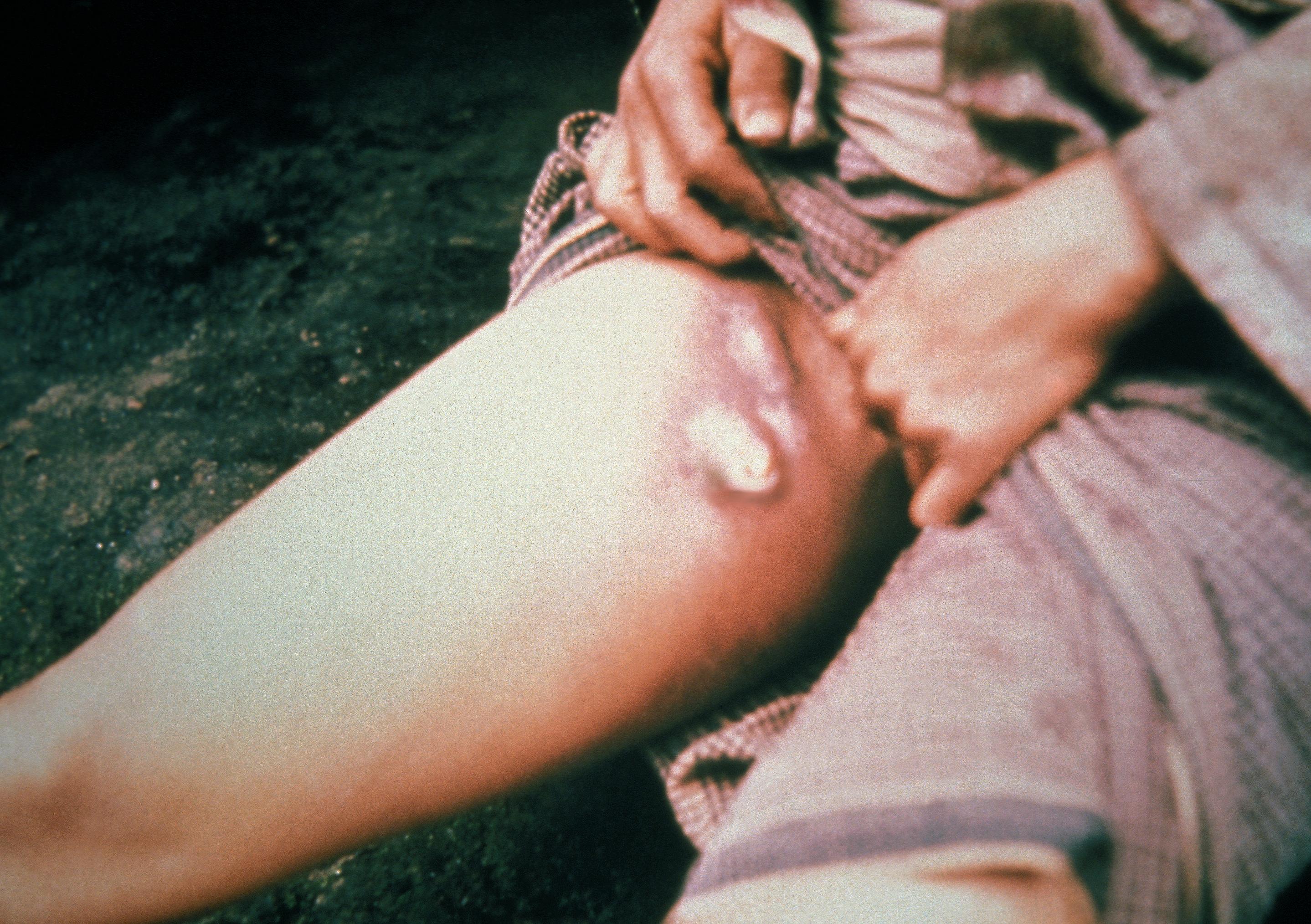 Inguinal bubo from bubonic plague symptoms showing swollen lymph node