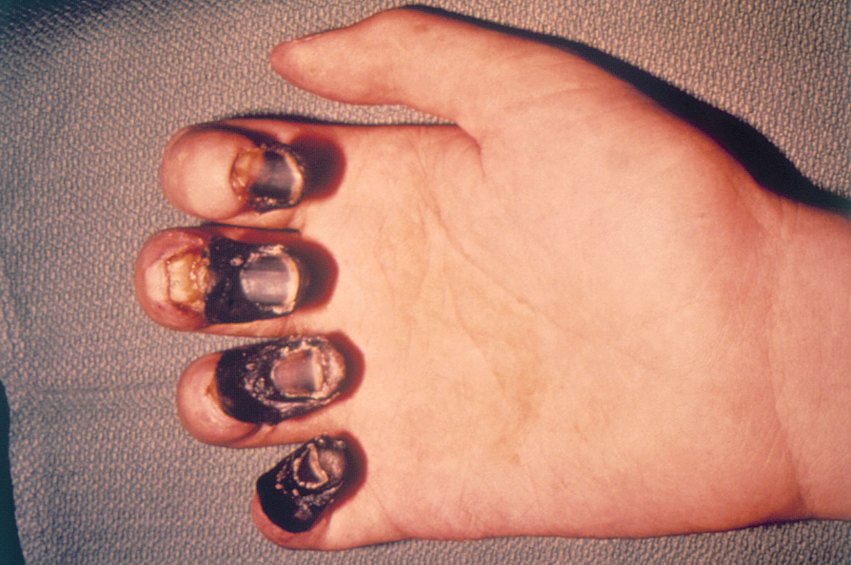 Gangrene of the hand in a plague patient showing blackened tissue from septicemic progression of untreated bubonic plague
