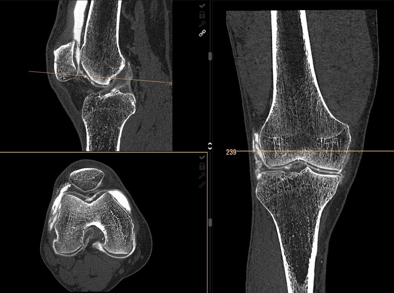 A knee imaged with photon-counting CT