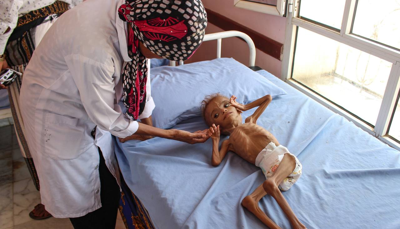 A nurse cares for a severely malnourished two-year-old child in Abs, Yemen, in September 2018