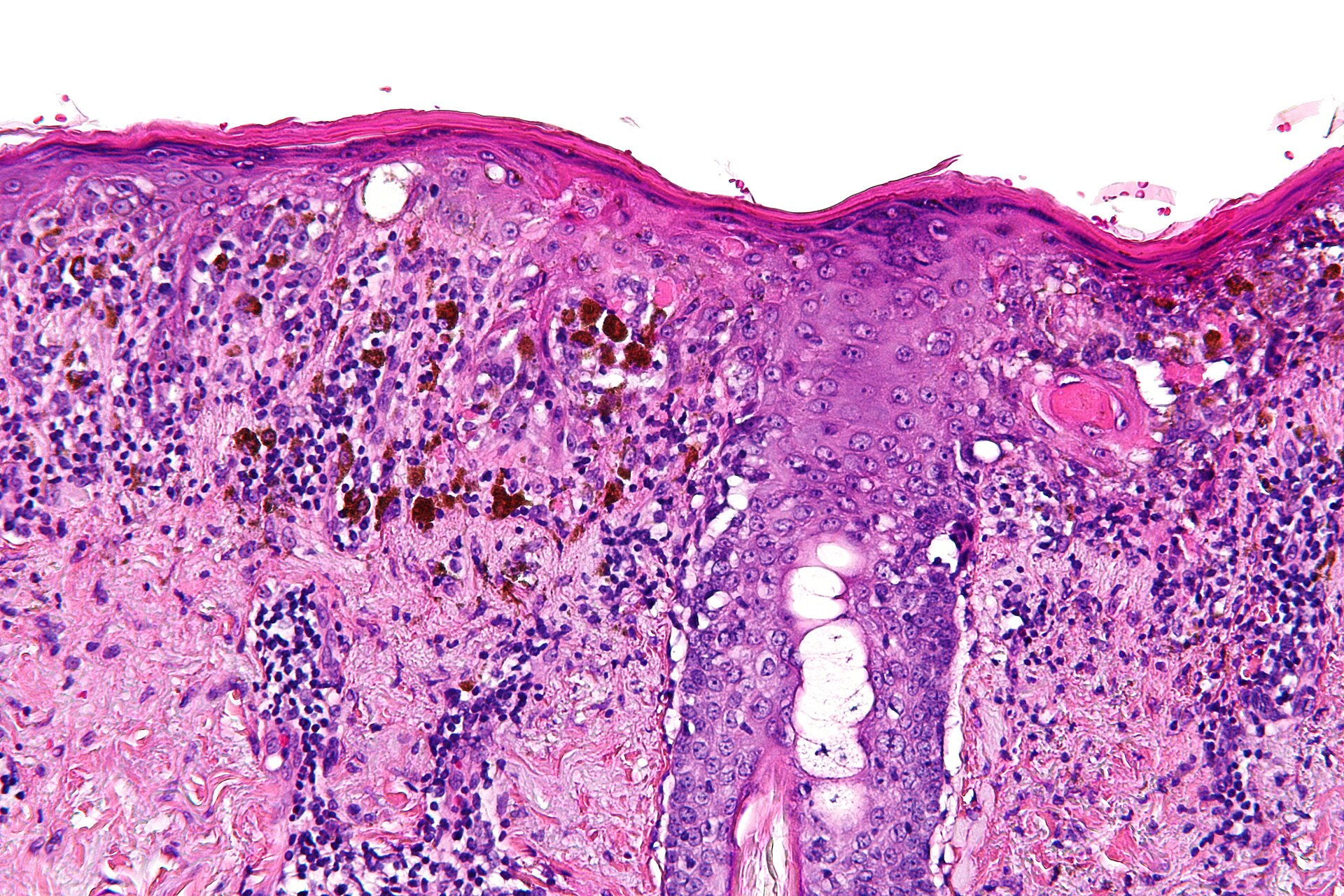 Melanoma cells under high magnification — the high-risk melanoma the Moderna intismeran vaccine trial targeted after surgery