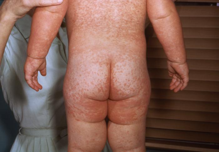 Child with the characteristic red blotchy rash of measles