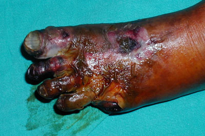 Dry gangrene blackening the foot, the tissue death seen in severe septicemic plague