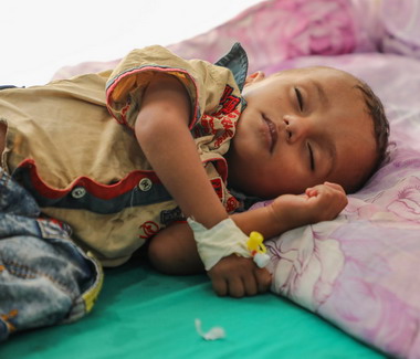 A malnourished child in Yemen — acute child malnutrition is surging, UNICEF warned in September 2026.
